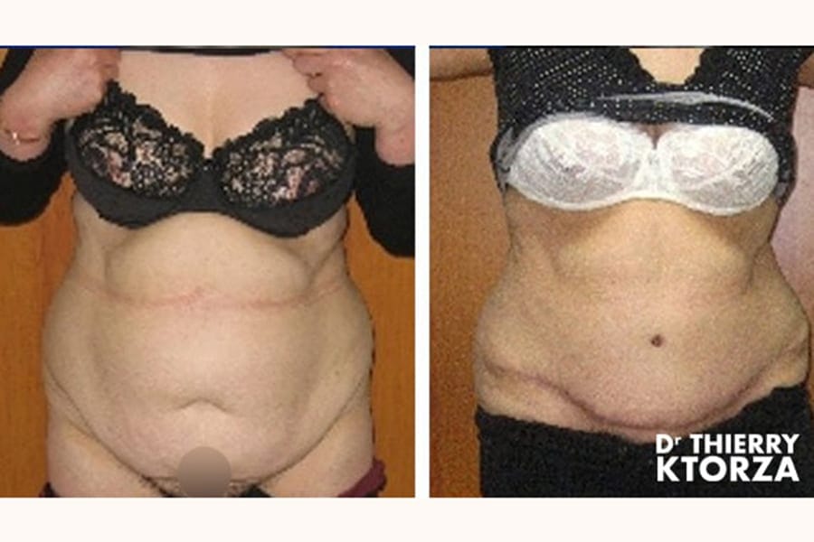 abdominoplastie-photo-avant-apres-dr-ktorza-16 abdominoplastie-photo-avant-apres-dr-ktorza-16