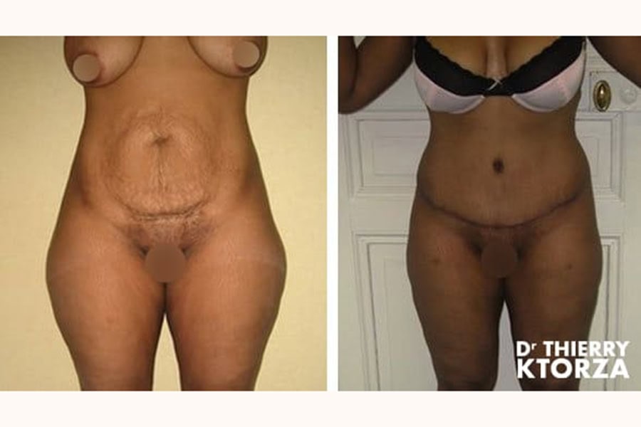 abdominoplastie photo avant apres dr ktorza 17 abdominoplastie photo avant apres dr ktorza 17