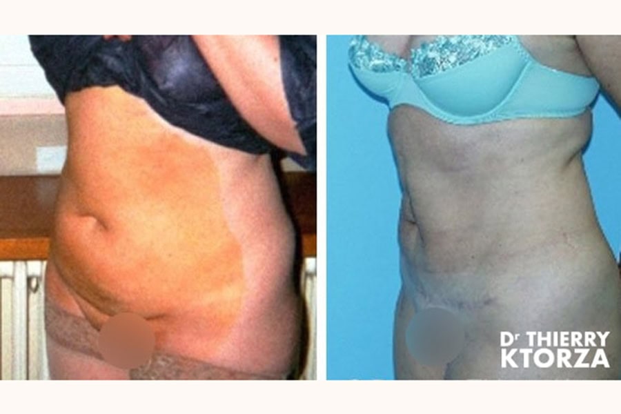 abdominoplastie photo avant apres dr ktorza 18 abdominoplastie photo avant apres dr ktorza 18