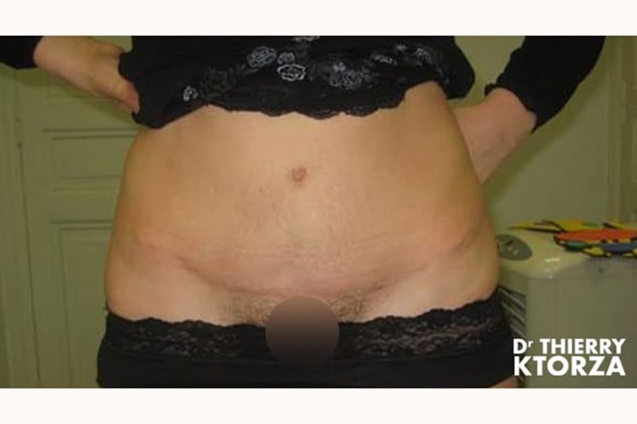 abdominoplastie photo avant apres dr ktorza 19 abdominoplastie photo avant apres dr ktorza 19