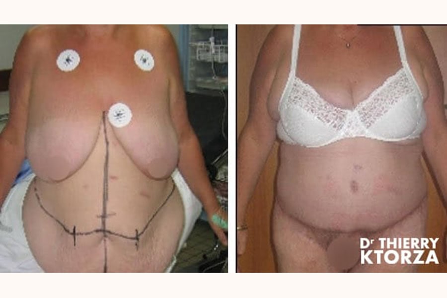 abdominoplastie photo avant apres dr ktorza 20 abdominoplastie photo avant apres dr ktorza 20