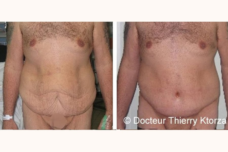 abdominoplastie photo avant apres dr ktorza 21 abdominoplastie photo avant apres dr ktorza 21