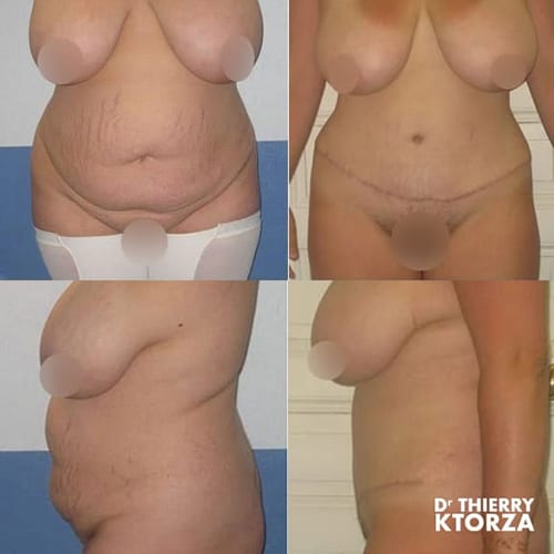 abdominoplastie photo avant apres dr ktorza 5 abdominoplastie photo avant apres dr ktorza 5