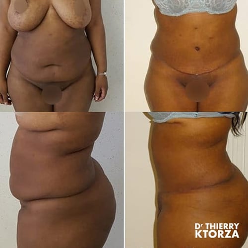 abdominoplastie photo avant apres dr ktorza 6 abdominoplastie photo avant apres dr ktorza 6