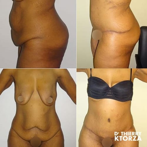 abdominoplastie photo avant apres dr ktorza 7 abdominoplastie photo avant apres dr ktorza 7