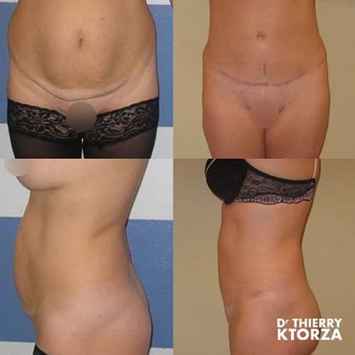 abdominoplastie photo avant apres dr ktorza 8 abdominoplastie photo avant apres dr ktorza 8
