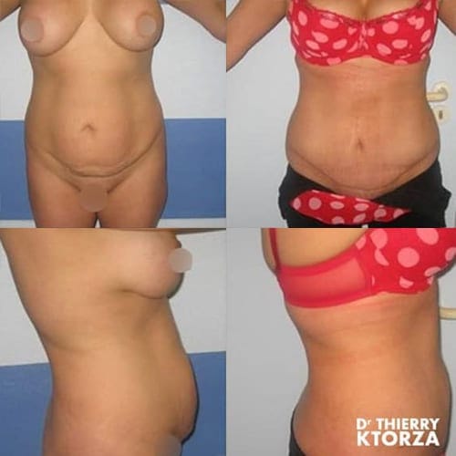 abdominoplastie photo avant apres dr ktorza 9 abdominoplastie photo avant apres dr ktorza 9