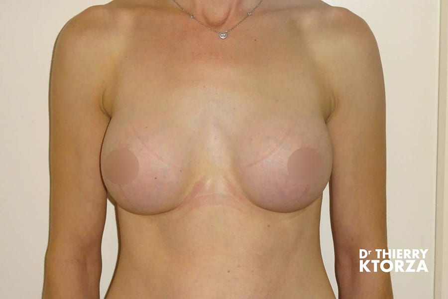 augmentation mammaire photo apres 1