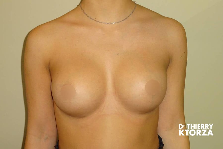 augmentation mammaire photo apres 10