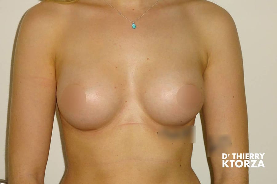 augmentation mammaire photo apres 4