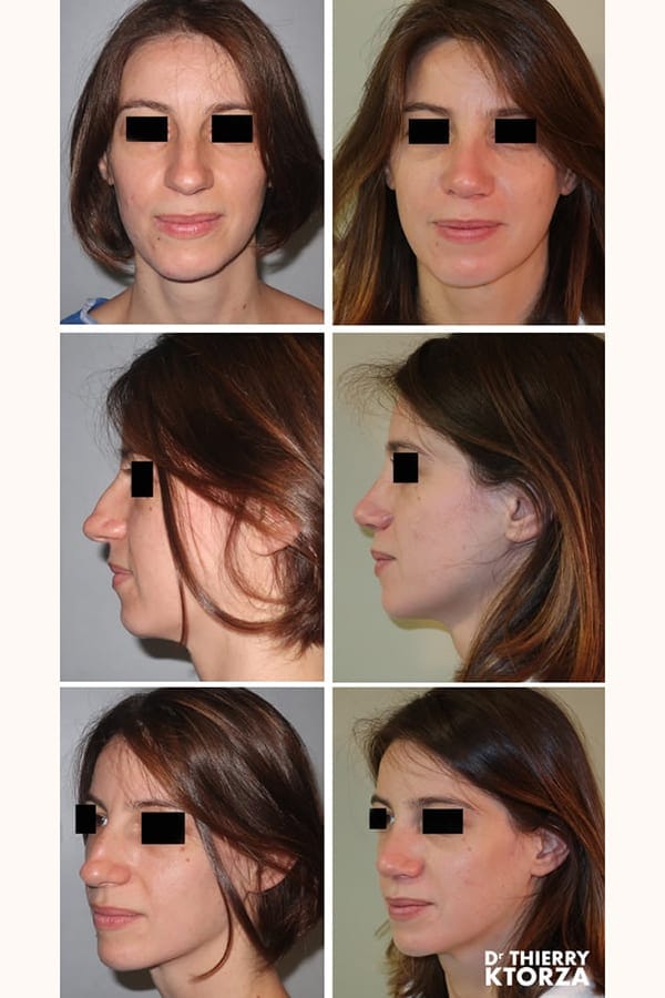 catalogue photos rhinoplastie 1 catalogue photos rhinoplastie 1