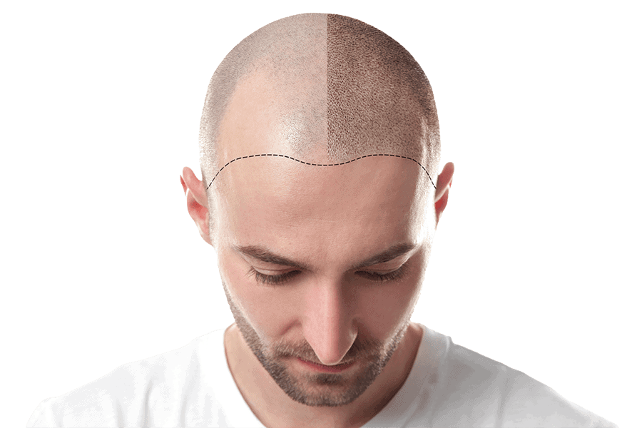 greffe cheveux chirurgie esthetique homme tempes calvitie dr thierry ktorza specialiste medecine esthetique paris greffe cheveux chirurgie esthetique homme tempes calvitie dr thierry ktorza specialiste medecine esthetique paris