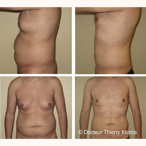 liposuccion-avant-apres-bras-ventre-homme liposuccion-avant-apres-bras-ventre-homme
