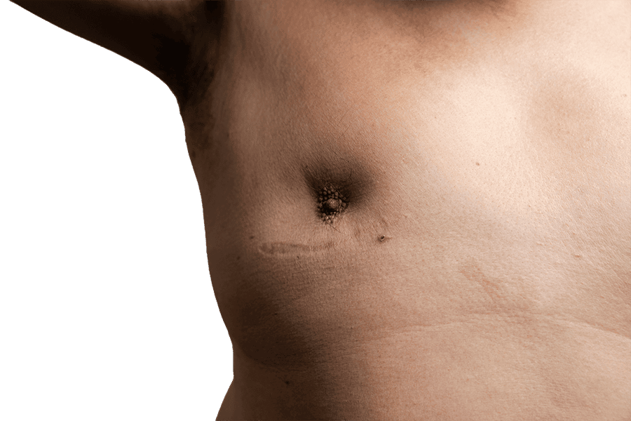 mamelons ombiliques chirurgie esthetique femme poitrine teton rentre dr thierry ktorza specialiste medecine esthetique paris