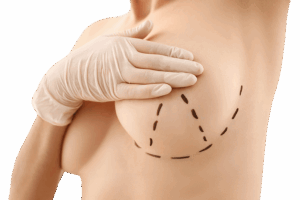 refaire les seins dr ktorza chirurgie esthetique medecine esthetique paris refaire les seins dr ktorza chirurgie esthetique medecine esthetique paris