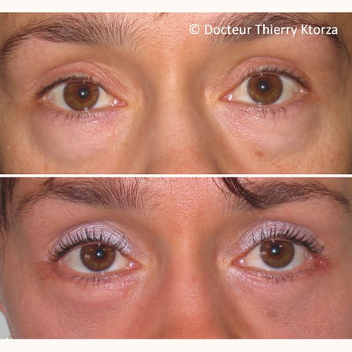photo avant apres blepharoplastie paupieres inferieures femme 29 ans
