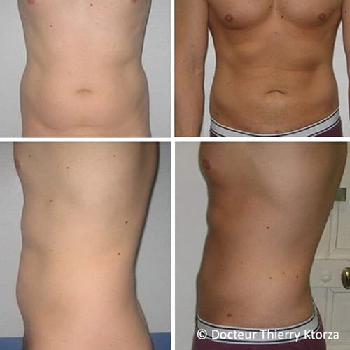 photo-avant-apres-liposuccion-homme-32-ans photo-avant-apres-liposuccion-homme-32-ans