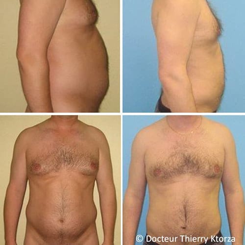 photo-avant-apres-liposuccion-homme-40-ans photo-avant-apres-liposuccion-homme-40-ans