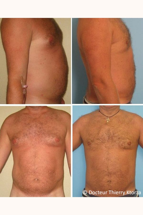 photo-avant-apres-liposuccion-homme-42-ans photo-avant-apres-liposuccion-homme-42-ans
