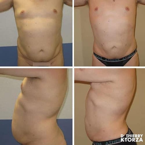 photo-avant-apres-liposuccion-homme-ktorza-paris photo-avant-apres-liposuccion-homme-ktorza-paris
