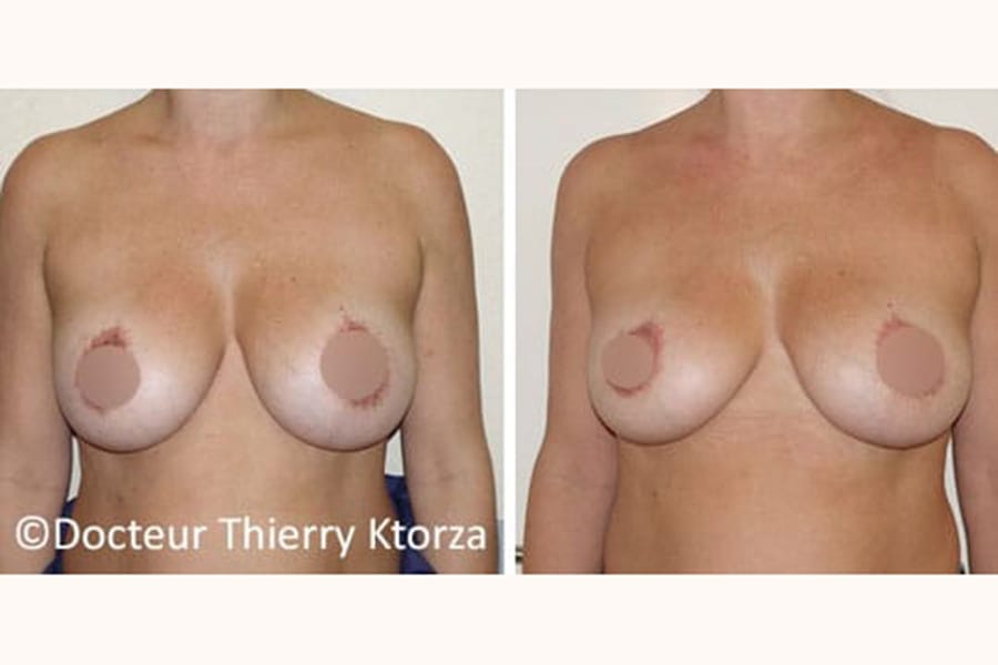 photo avant apres retrait implant mammaire ktorza paris 4 photo avant apres retrait implant mammaire ktorza paris 4