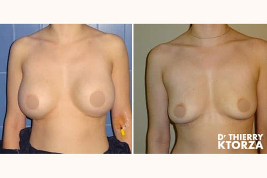 photo avant apres retrait implant mammaire ktorza paris 5 photo avant apres retrait implant mammaire ktorza paris 5