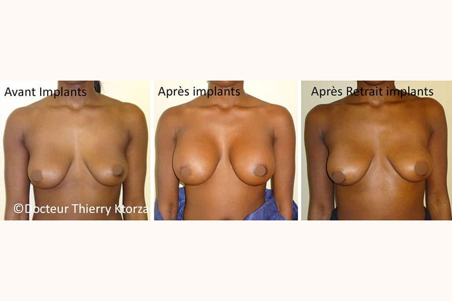 photo avant apres retrait implant mammaire ktorza paris 6 photo avant apres retrait implant mammaire ktorza paris 6