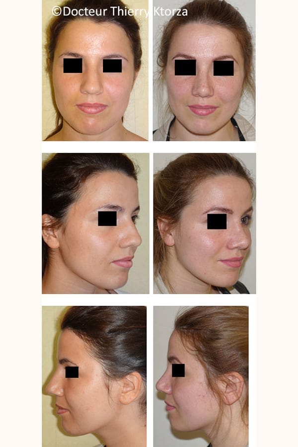 photo avant apres rhinoplastie femme 23 ans photo avant apres rhinoplastie femme 23 ans
