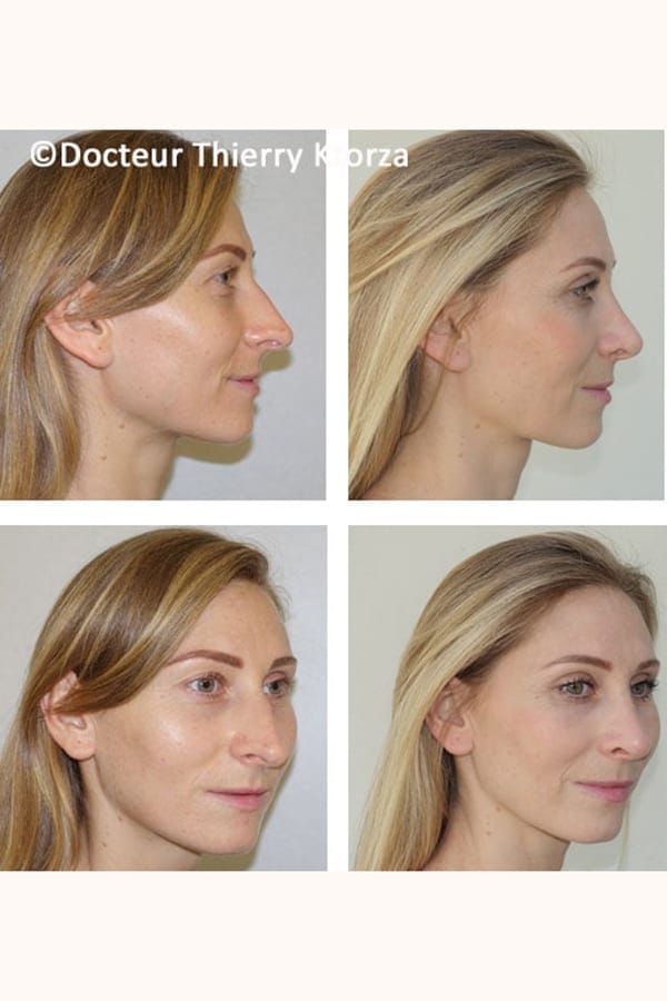 photo avant apres rhinoplastie femme 31 ans photo avant apres rhinoplastie femme 31 ans