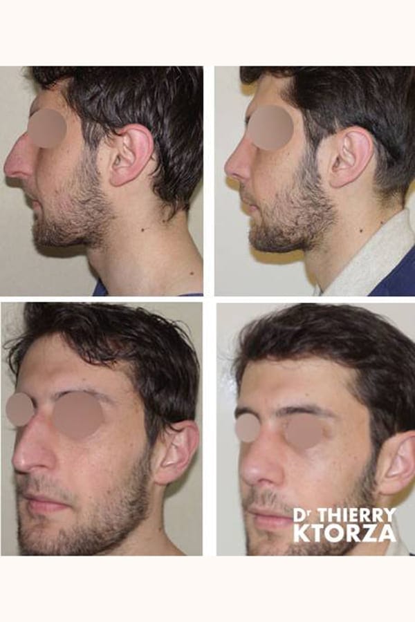 photo avant apres rhinoplastie homme 30 ans photo avant apres rhinoplastie homme 30 ans