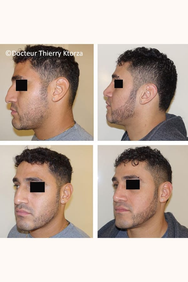 photo avant apres rhinoplastie homme photo avant apres rhinoplastie homme
