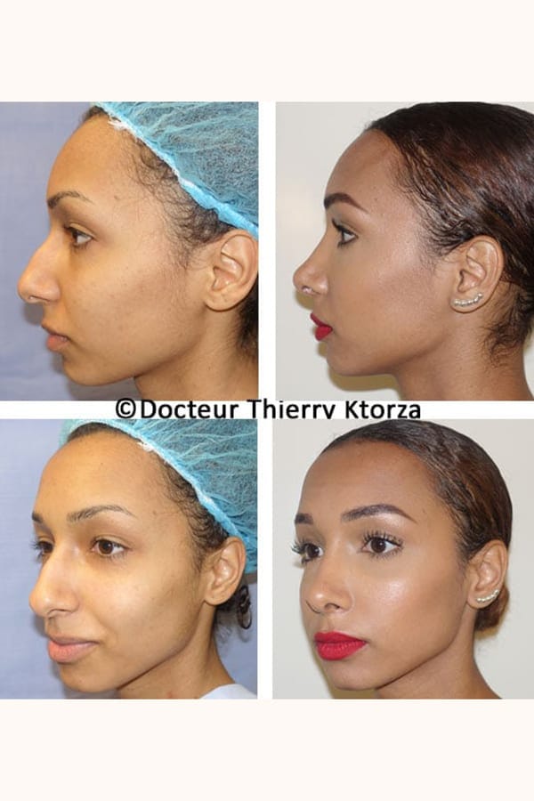 photo avant apres rhinoplastie naturelle photo avant apres rhinoplastie naturelle