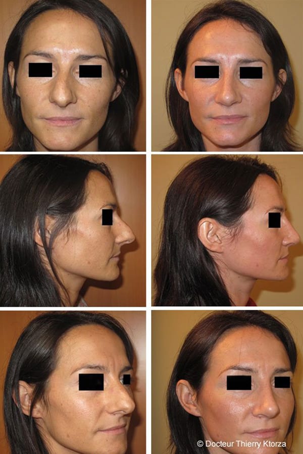rhinoplastie avant apres pointe projetee rhinoplastie avant apres pointe projetee