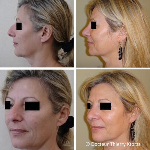rhinoplastie bosse nez rhinoplastie bosse nez