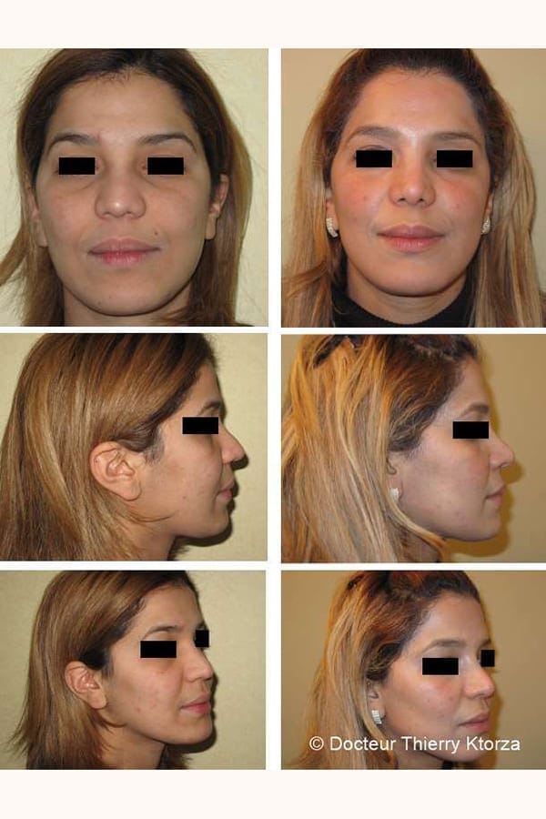 rhinoplastie correction pointe plongeante rhinoplastie correction pointe plongeante