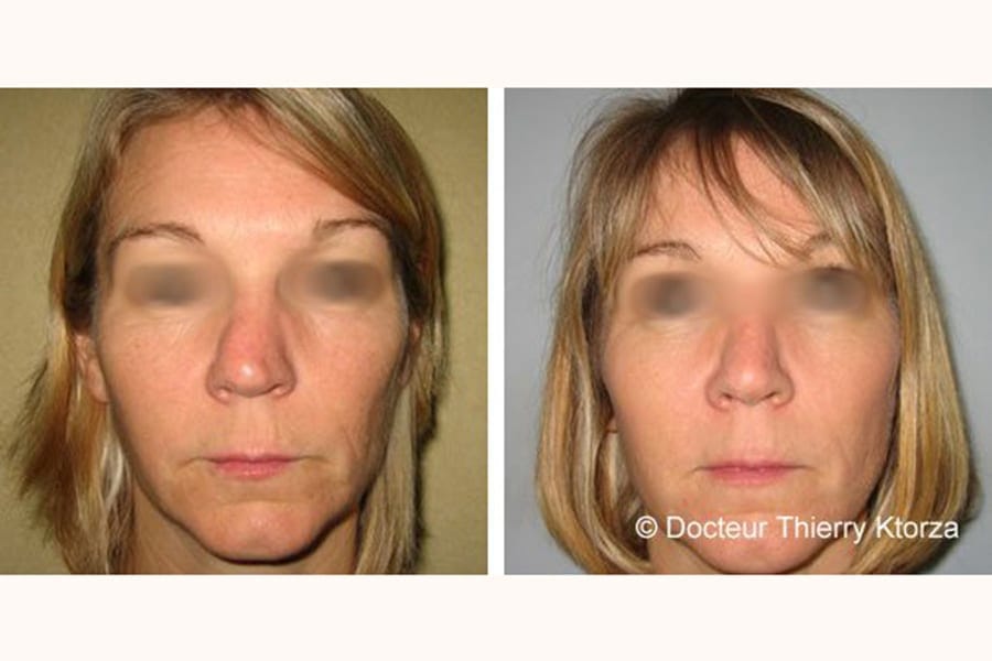 rhinoplastie deviation nez avant apres rhinoplastie deviation nez avant apres