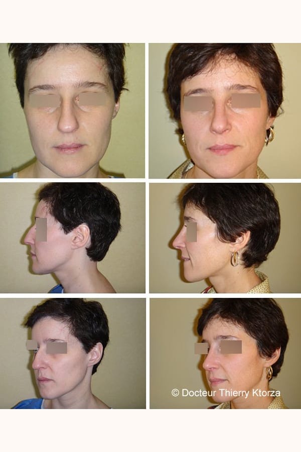 rhinoplastie docteur ktorza traitement pointe nez rhinoplastie docteur ktorza traitement pointe nez