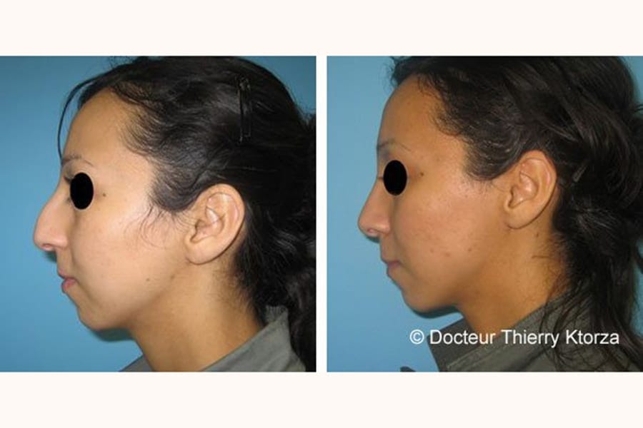rhinoplastie equilibre visage avant apres rhinoplastie equilibre visage avant apres