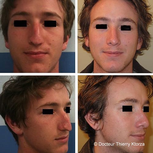 rhinoplastie jeune homme avant apres rhinoplastie jeune homme avant apres
