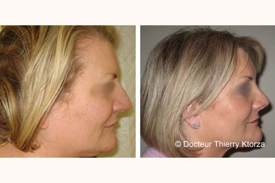 rhinoplastie lifting blepharoplasyie avant apres rhinoplastie lifting blepharoplasyie avant apres