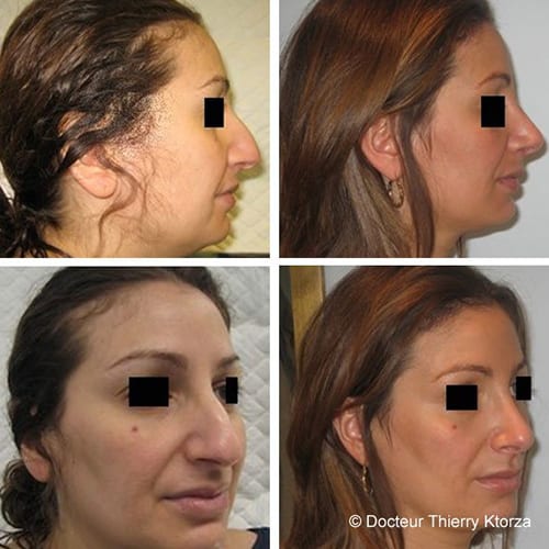 rhinoplastie lipoaspiration double menton avant apres rhinoplastie lipoaspiration double menton avant apres