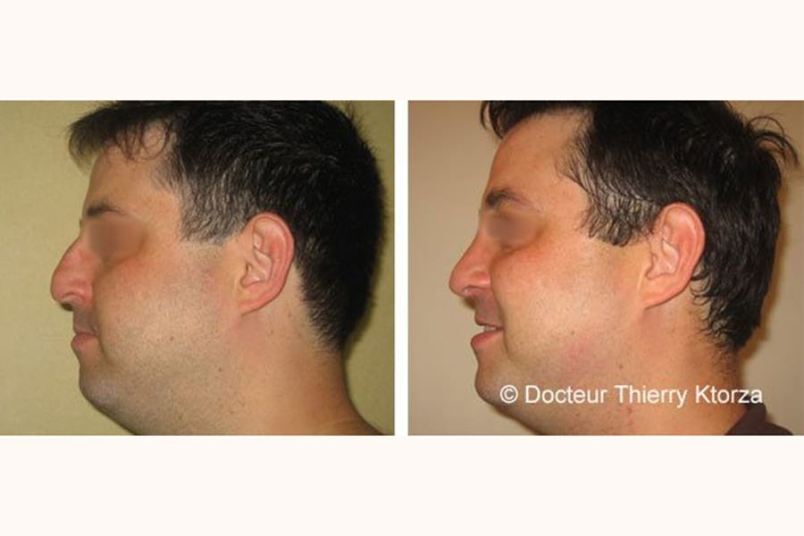 rhinoplastie peau epaisse avant apres rhinoplastie peau epaisse avant apres