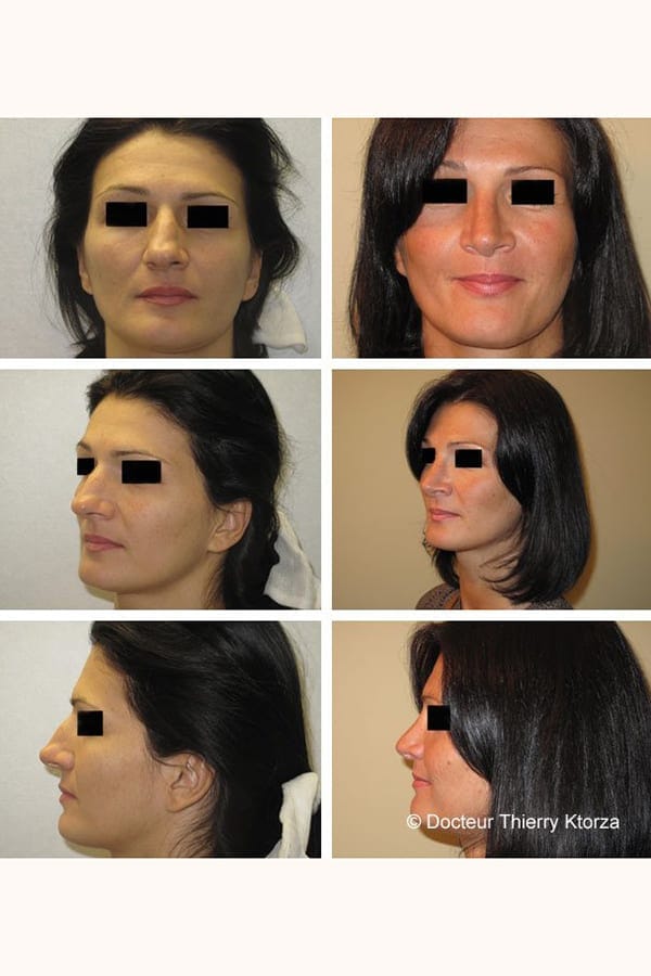 rhinoplastie pointe asymetrique avant apres rhinoplastie pointe asymetrique avant apres