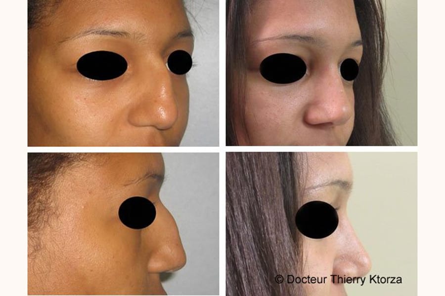 rhinoplastie pointe importante avant apres rhinoplastie pointe importante avant apres