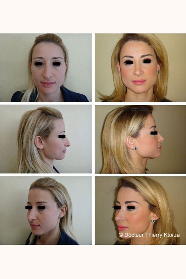 rhinoplastie pointe nez tombant long rhinoplastie pointe nez tombant long