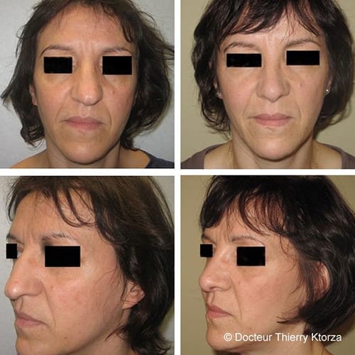 rhinoplastie pointe tombante avant apres rhinoplastie pointe tombante avant apres