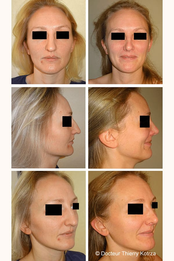 rhinoplastie pointe tombante rhinoplastie pointe tombante