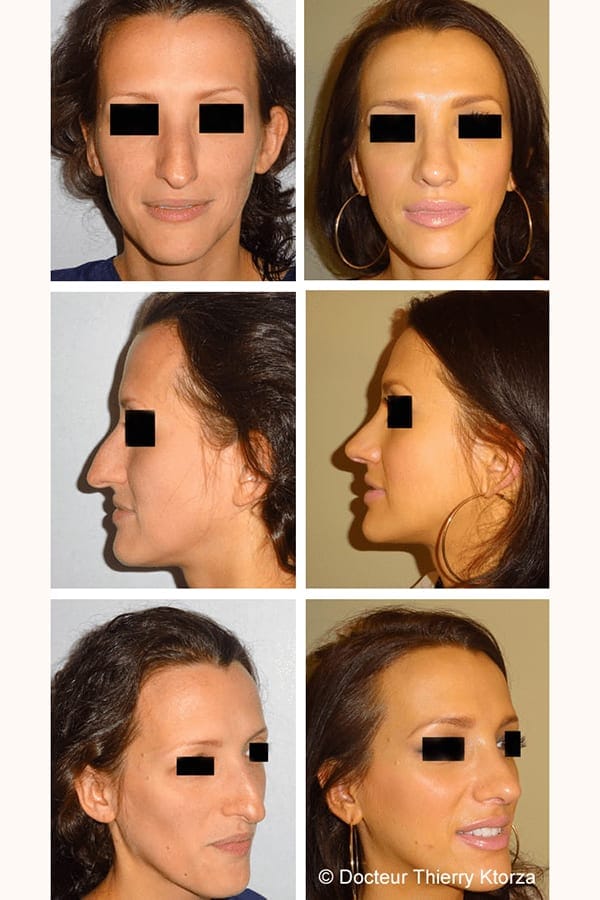 rhinoplastie pointe tres plongeante rhinoplastie pointe tres plongeante