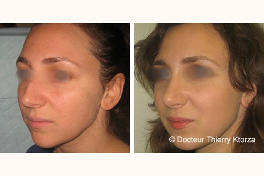 rhinoplastie recul pointe avant apres rhinoplastie recul pointe avant apres