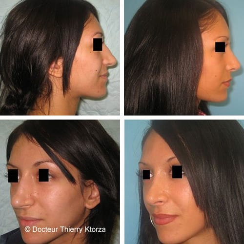 rhinoplastie traitement bosse avant apres rhinoplastie traitement bosse avant apres